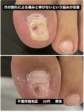 巻き爪じゅん 千葉駅前店/爪が割れ違和感伸びない悩み改善