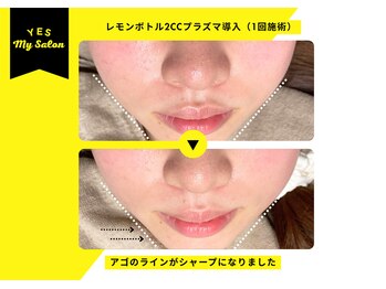 イエス マイサロン(yes My Salon)/レモンボトル施術例