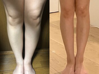 ルーナジェーナ(Luna llena)/それ、肥満ではなく浮腫みかも。