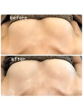 ポノ(PONO)/ビフォーアフター【バスト】