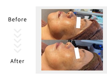 アブニールブリヨン/ハーブピーリング　Before After