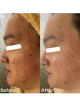 マスカレード 品川(Masquerade)/【症例写真】施術1回