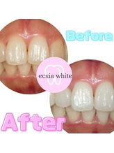 エクシアホワイトニング 武蔵小杉店/ビフォーアフター