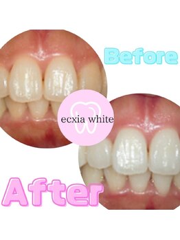 エクシアホワイトニング 武蔵小杉店/ビフォーアフター