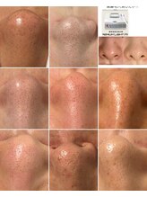 メディカルサロン ティアラ 亀有本店/【光フォト】毛穴befo→after