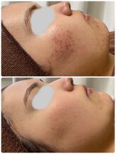 ビオプラス(BioPlus+)/ハーブピーリング/川崎