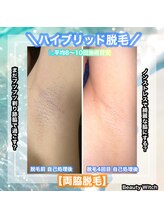 ビューティ ウィッチ(Beauty Witch)/脇の黒ずみもお任せ下さい！