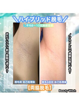 ビューティ ウィッチ(Beauty Witch)/脇の黒ずみもお任せ下さい！