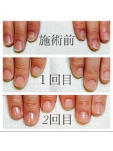 ネイルサロン アルファガーデン 町田本店(α garden)/最強のネイルケア　症例写真