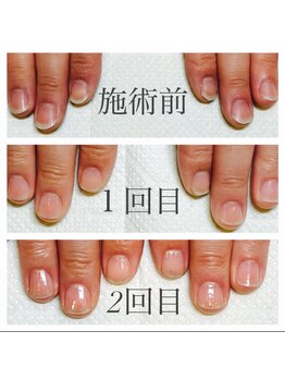 ネイルサロン アルファガーデン 町田本店(α garden)/最強のネイルケア　症例写真