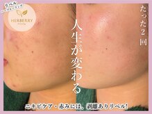 ハーバリー ハーブピーリング 大阪梅田店(HERBERRYハーブピーリング)/梅田ハーブピーリングHERBERRY