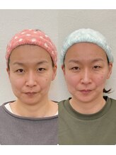 小顔22 ボルティ 赤坂支店(Bolty)/【悩み】40代：顔の左右差