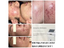 BUB 立川の雰囲気（都度払いで始めやすい本気の肌ケア　ニキビ予防迄丁寧にサポート）