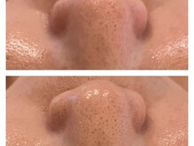 ヨリ(yori)/毛穴の黒ずみは見極めが重要