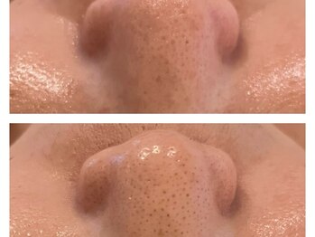 ヨリ(yori)/毛穴の黒ずみは見極めが重要