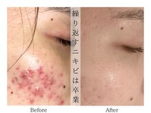 リララ(lelala)/ビフォーアフター☆