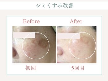 トータルビューティー ゆみえエステ(Total Beauty)/リベルハーブピーリング