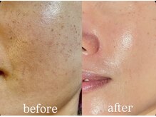 ピュアグレース 自由が丘の雰囲気(エンビロン最高峰120分2週間に一度4回目でこの効果!シミ たるみ)