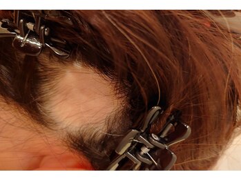 はる鍼灸整骨院/髪の悩み◇あきらめないで↓初回