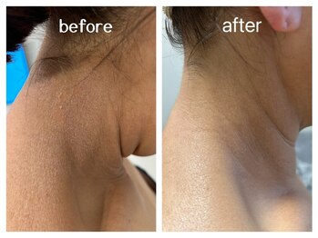 ノイ(noi.)/ハード・ハーブピーリング症例