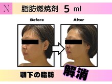 ナチュリ センター南院(NACHUL)/二重顎改善★