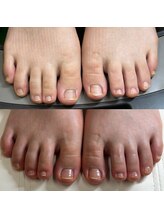 リリ(lili)/フットネイルスキンケア1回目