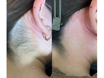 アンドエス 六本木(and S.)/女性うなじ脱毛≪WAX脱毛/脱毛≫