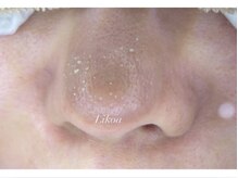 リコア(Likoa)/毛穴の汚れ