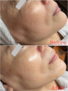 ティアーナ(Tiaana)/ララピール5回アフター