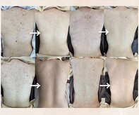 スキンプローズ(skinprose)