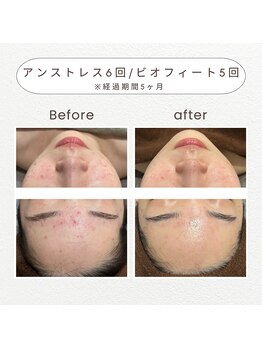 ノドカ 新市街店(NODOKA)/赤みやニキビ肌のお悩みを改善