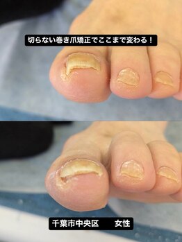 巻き爪じゅん 千葉駅前店/切らない巻き爪矯正で変わる足元