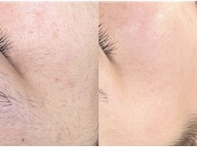 リノミノ(lino'mino)の雰囲気（加工なし【顔Wax症例】Waxで肌表面を整理/化粧ノリ/浸透力アップ）