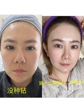 ステップイン(Step in)/ダイヤモンドピールプログラム