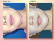 ジュリア オージェ 梅田店/ビフォーアフター/イドラリフト