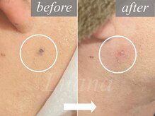 ルアナ(Luana)/【黒く酸化/詰まり】一瞬で改善