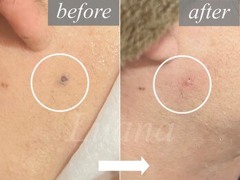 ルアナ(Luana)/【黒く酸化/詰まり】一瞬で改善