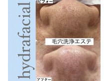 ヴィアージュ/汚れごっそり毛穴黒ずみ解消◎