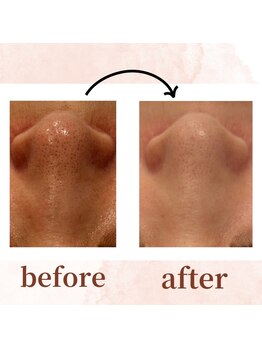 エルブラン(Aile-blanc)/毛穴/小顔/肩こり/フェイシャル 