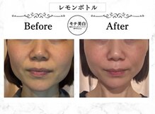 モテ美白