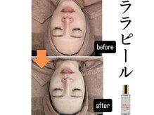 フルールドリス(FLEUR DE LIS)の雰囲気（今話題ララピール【ピーリング／毛穴／美白ケア／はり・つや】）