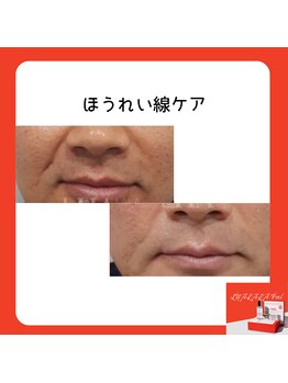 フェリス(feliz)/ララピール[ほうれい線ケア]