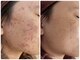 サロンドエルサ(Salon de ELSA)の写真/毛穴の黒ずみやニキビ・ザラつきをオーガニックケアで改善！国産ハーブピーリングでつるつる美肌へ◎