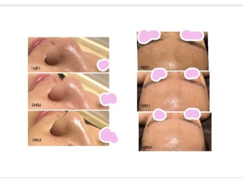 バニーヒップ(Bunny Hip)/カーボキシー