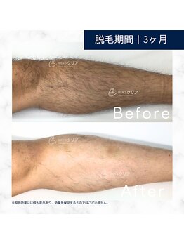 メンズクリア 武蔵小杉店/【メンズクリア】お客様の施術例