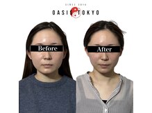 オアシス トウキョウ(Oasis Tokyo)の雰囲気（美容整形なしの小顔術【小顔/小顔矯正/美容鍼】）