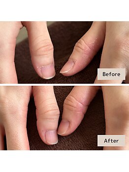 長年の辛い手荒れやささくれ改善