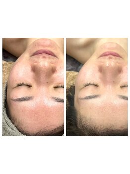 ホウレイ線・たるみ改善！予防ケア