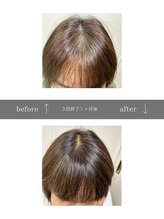 青空 天神大名店(SORA)/マイクロチップ頭皮 &nbsp;3回
