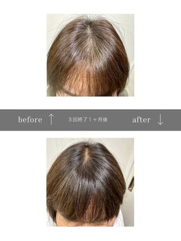 青空 天神大名店(SORA)/マイクロチップ頭皮 &nbsp;3回
